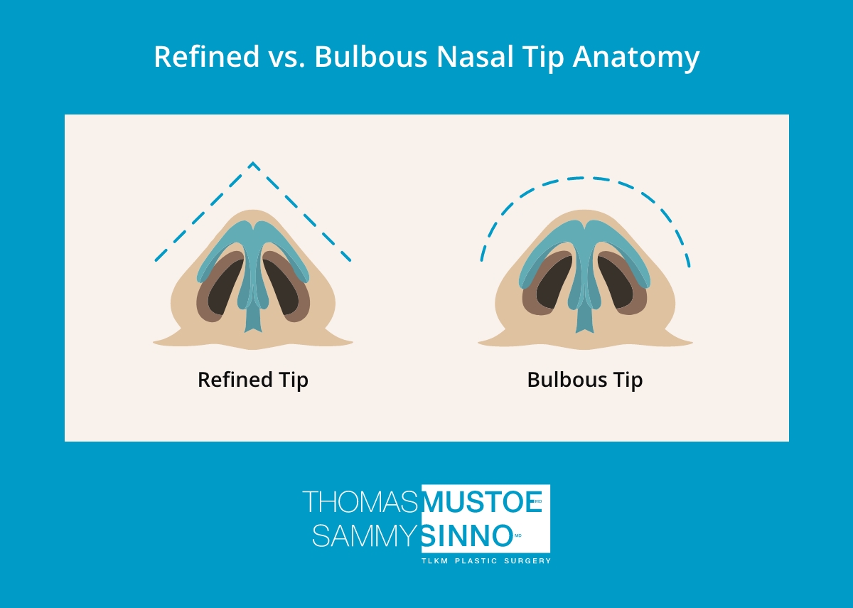 An infographic by TLKM Plastic Surgery comparing a refined nasal tip vs. a bulbous nasal tip. 