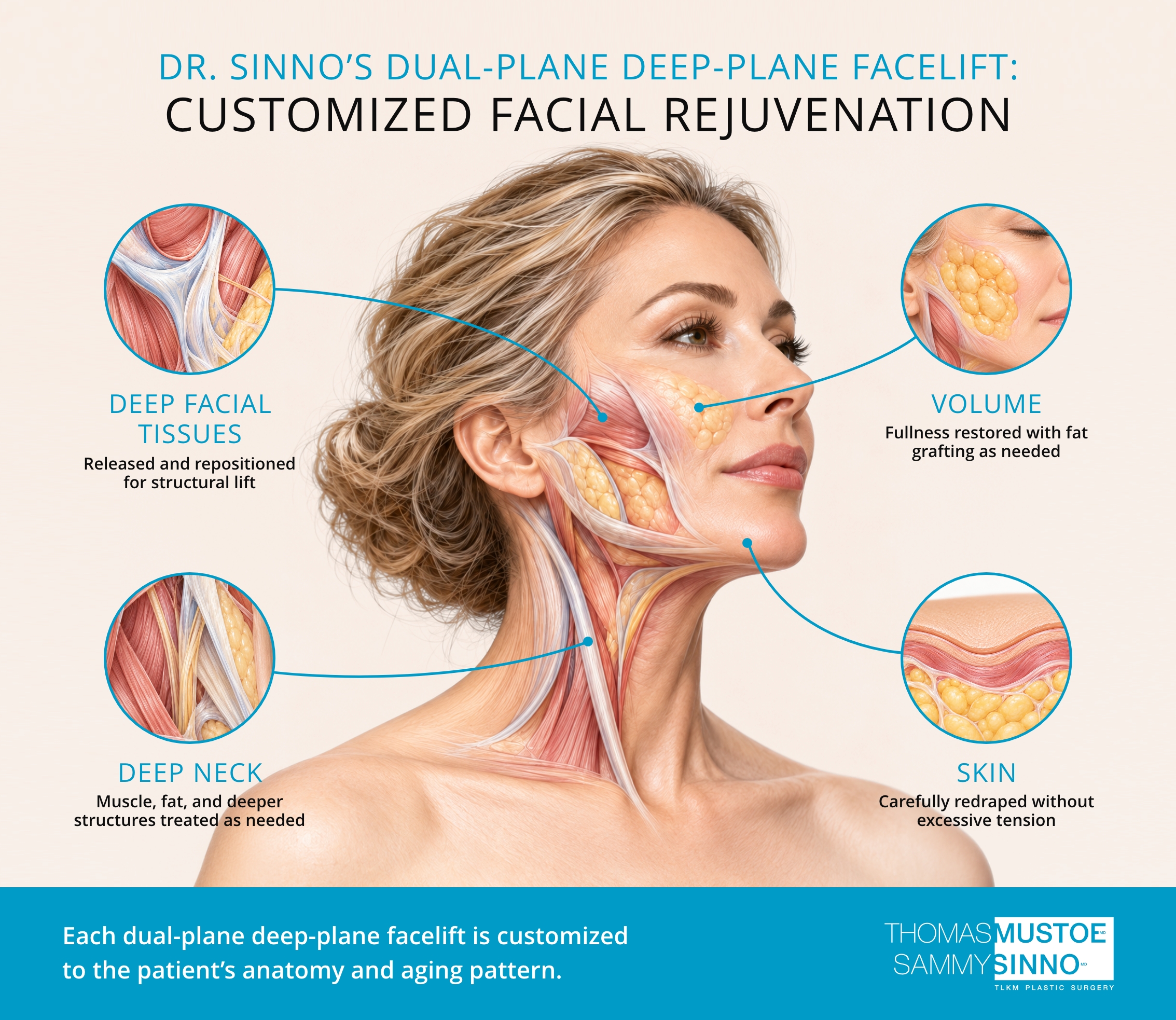 Dr. Sinno’s customized dual-plane facelift illustrated with four components: deep facial tissue lifting, deep neck treatment, skin redraping, and fat grafting as needed.